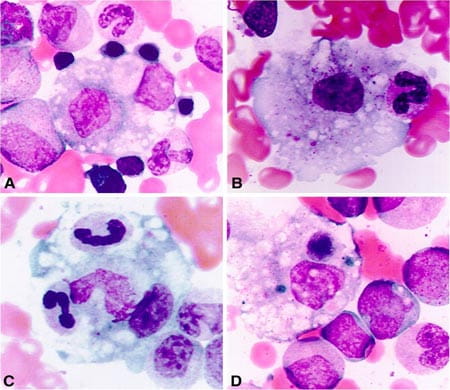 Activated macrophages phagocytosing hematopoietic elements in the bone marrow of an sJIA patient with MAS.